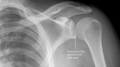 5 penyebab umum bahu bergeser