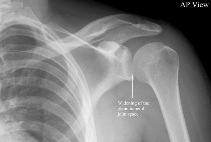 5 penyebab umum bahu bergeser