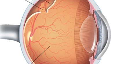 2 jenis pemeriksaan untuk mendiagnosis ablasi retina