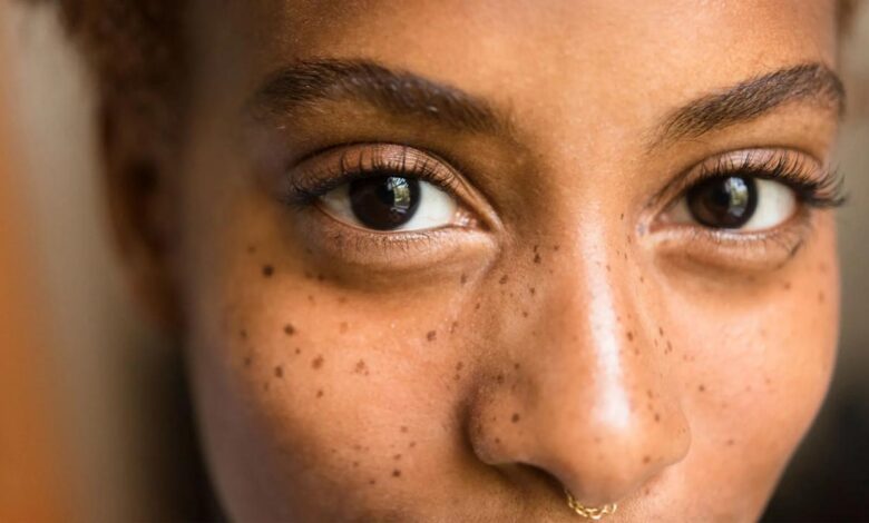 5 penyebab bintik bintik cokelat pada wajah