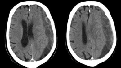 5 penyebab seseorang alami hematoma subdural