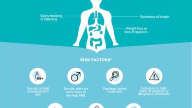 5 faktor yang tingkatkan risiko leukemia limfoblastik akut