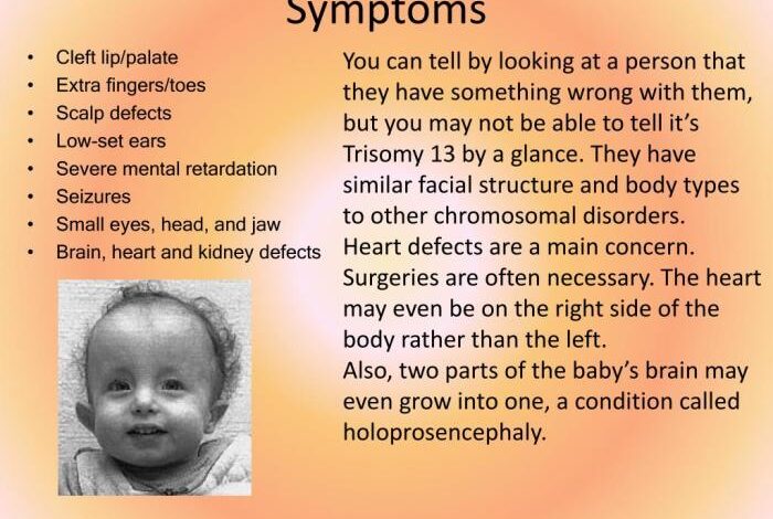 5 gejala trisomi 13 pada masa kehamilan