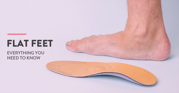 5 fakta menarik mengenai flat foot yang perlu diketahui