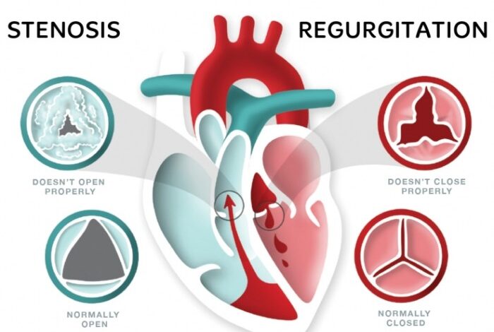 2 tipe penyakit katup jantung yang perlu diketahui