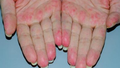 5 pemicu penyakit vaskulitis yang perlu kamu perhatikan