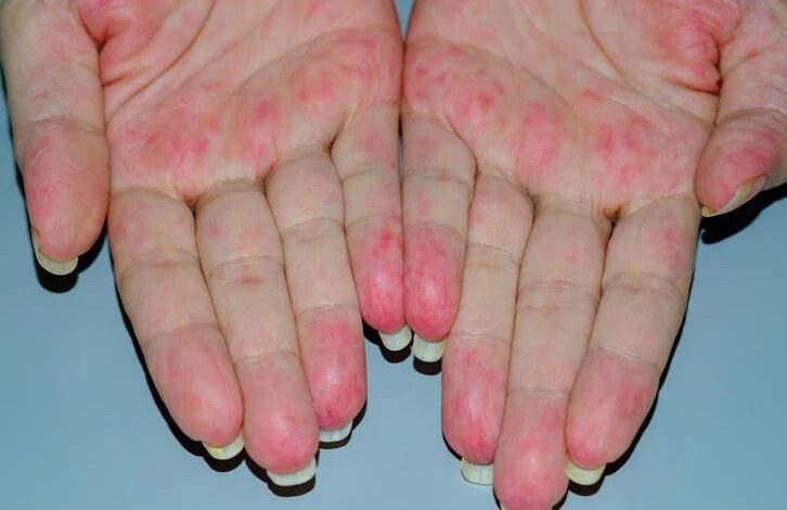 5 pemicu penyakit vaskulitis yang perlu kamu perhatikan