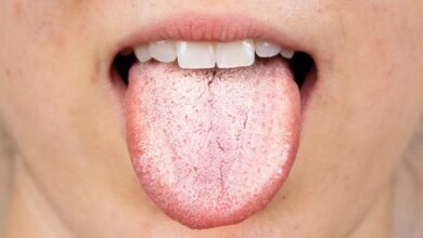 5 faktor yang meningkatkan risiko terkena oral thrush