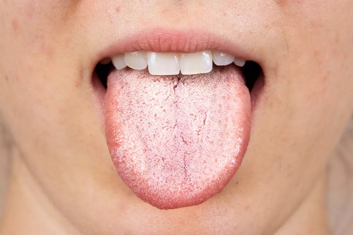 5 faktor yang meningkatkan risiko terkena oral thrush