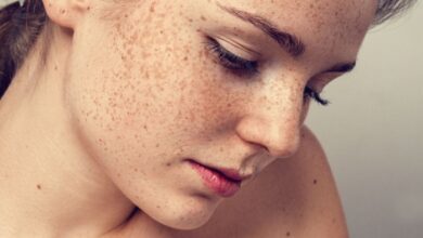 5 fakta tentang freckle yang menarik untuk diketahui