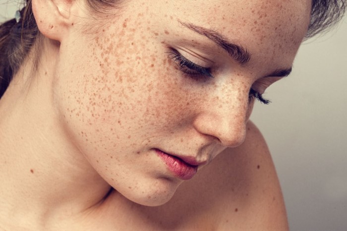 5 fakta tentang freckle yang menarik untuk diketahui