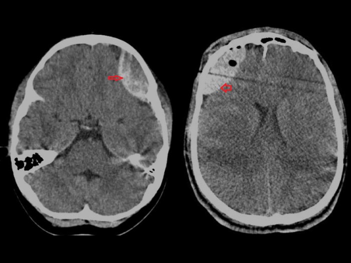 5 komplikasi akibat epidural hematoma