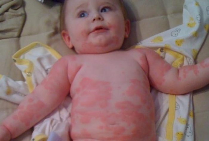 5 menu mpasi untuk bayi yang alergi susu