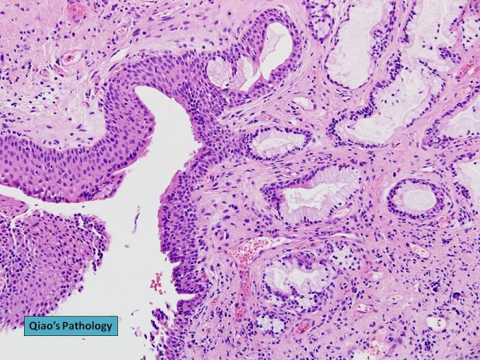 5 penanganan yang bisa dilakukan saat terkena kista bartholin