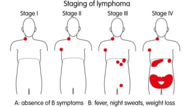 5 penanganan yang bisa dilakukan untuk mengobati limfoma hodgkin