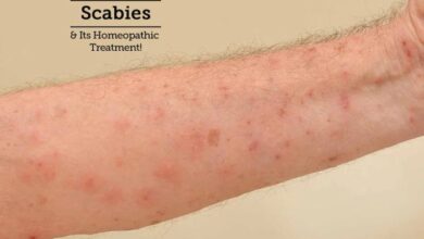 5 pengobatan alami untuk menyembuhkan kudis