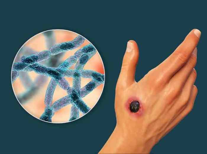 5 pemeriksaan penunjang jika terjangkit antraks