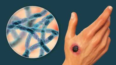 5 pemeriksaan penunjang jika terjangkit antraks