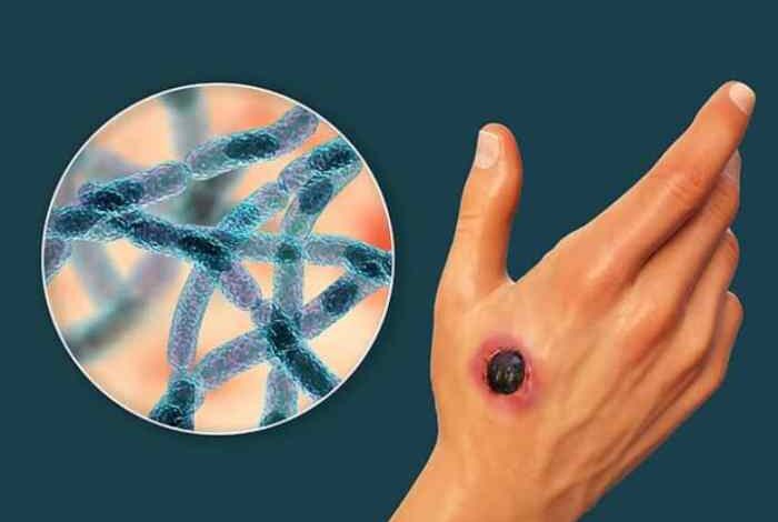 5 pemeriksaan penunjang jika terjangkit antraks