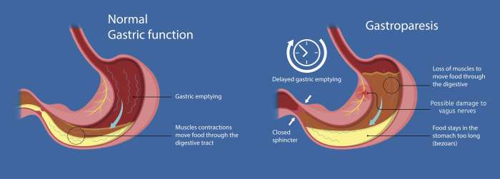 5 pemeriksaan untuk deteksi adanya gastroparesis