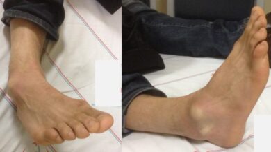 5 penanganan medis dislokasi sendi