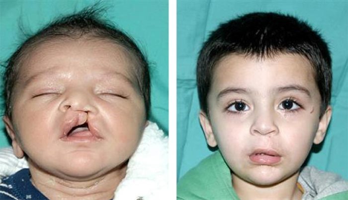 Lip cleft birth babies adulthood likely normal study surgically suggests repaired relatively defect healthday parents common research 5 penyebab bayi lahir dengan bibir sumbing