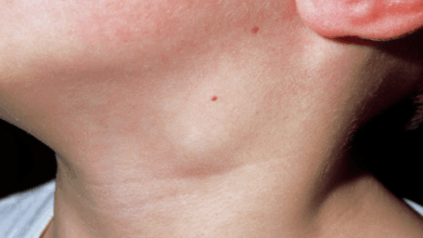 5 penyakit penyebab tumor colli yang perlu diwaspadai