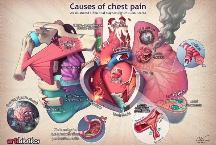 5 penyebab terjadinya nyeri dada pada wanita