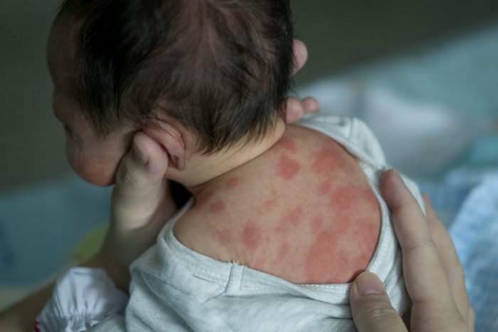 5 penyebab umum dermatitis atopik pada bayi