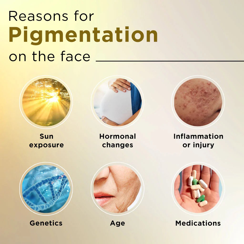 5 penyebab wanita alami hiperpigmentasi pada wajah