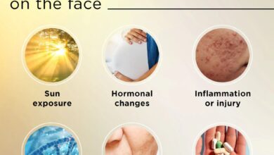 5 penyebab wanita alami hiperpigmentasi pada wajah