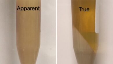 5 penyebab munculnya endapan putih pada air seni