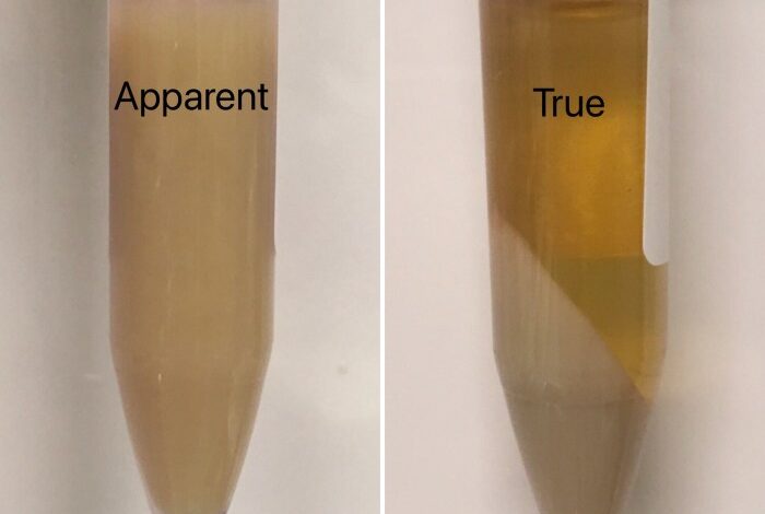 5 penyebab munculnya endapan putih pada air seni
