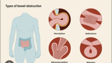 5 penyebab obstruksi usus terjadi pada anak anak