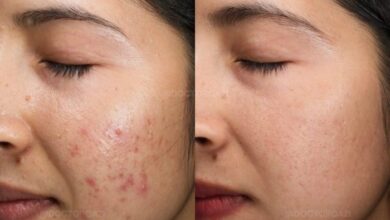 5 penyebab jerawat batu dan cara mencegahnya