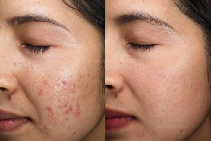 5 penyebab jerawat batu dan cara mencegahnya