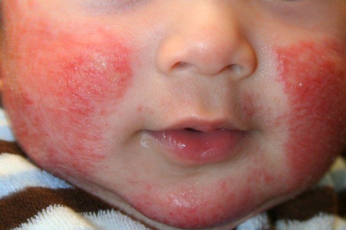 5 penyebab umum dermatitis atopik pada bayi