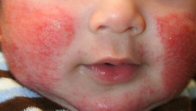 5 penyebab umum dermatitis atopik pada bayi